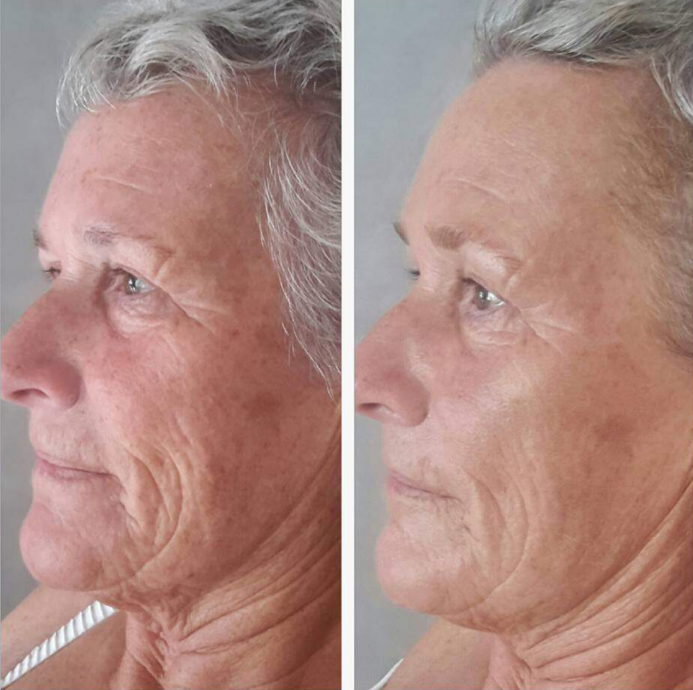 fruitzuurpeeling voor en na - bindweefselmassage gezicht